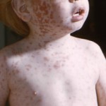 measles pic