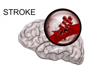 chiropractic-stroke